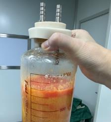 沅江水动力吸脂手术要做多久？